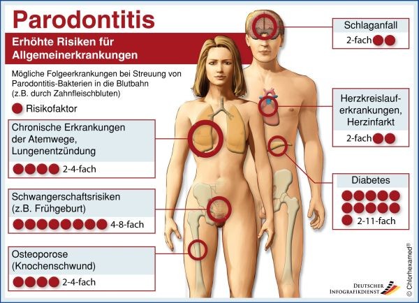 Dr.Pietschmann-Zahnaerzte_Stralsund_Parodontitis